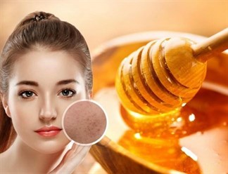 7 cách đắp mặt nạ mật ong trị mụn hiệu quả bạn nên thử