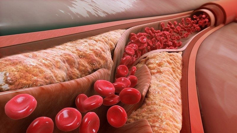 Động mạch bị hẹp lại do cholesterol trong máu tăng cao tạo thành mảng bám