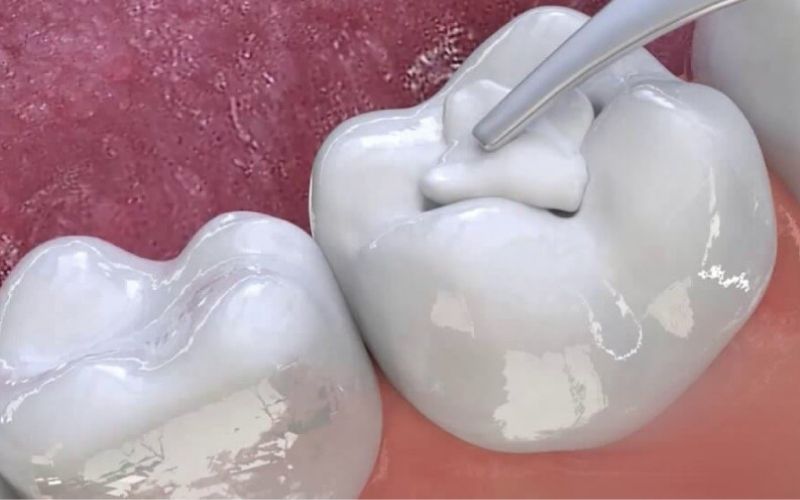 Tảo lục Chlorella có thể ứng dụng trong trám răng