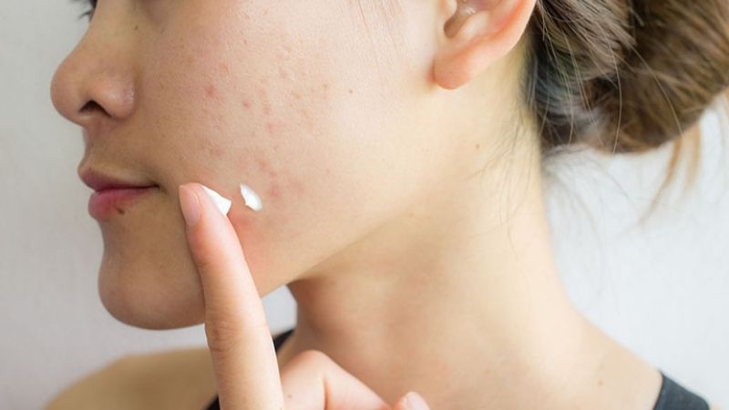 What is acne cream? Top best anti-acne creams today