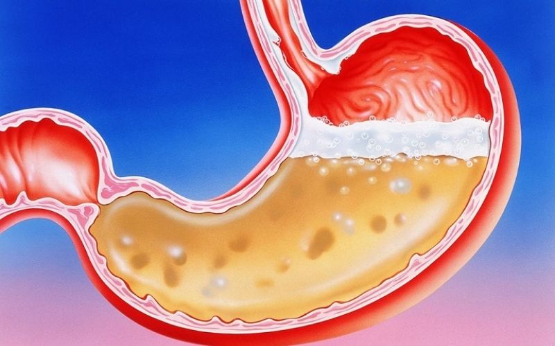 Nước khoáng kiềm thiên nhiên giúp cân bằng axit dạ dày