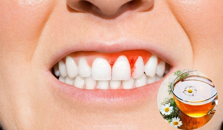 14 cách chữa viêm chân răng tại nhà với mẹo đơn giản