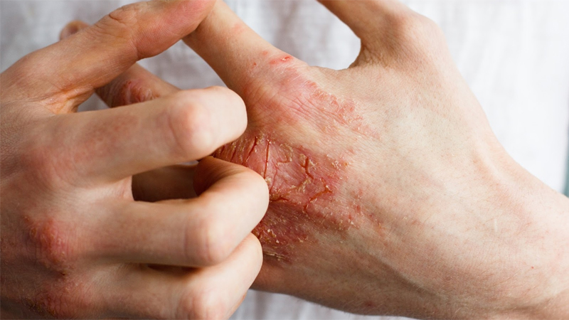 Một số người có thể gặp phản ứng viêm da tiếp xúc sau khi bôi gel nha đam