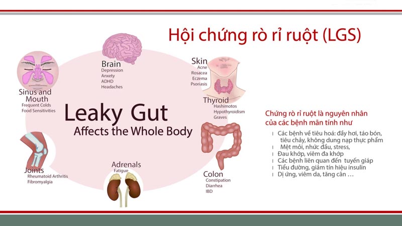 What is leaky gut syndrome? Diet for people with leaky gut