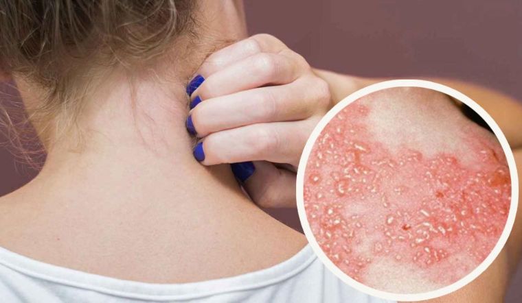 Bệnh zona thần kinh kiêng gì để mau khỏi, ít để lại sẹo?