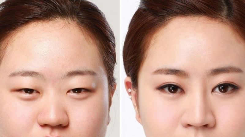 What to eat before double eyelid surgery?