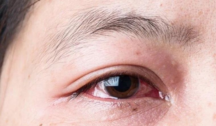 Viêm kết mạc (đau mắt đỏ) là triệu chứng của bệnh Covid-19