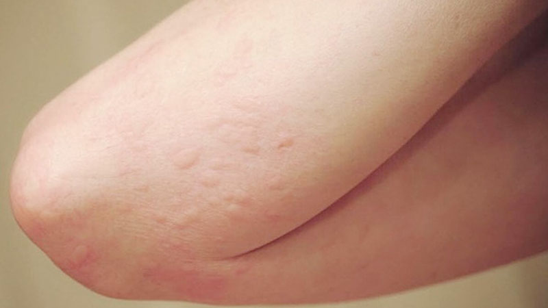 Dùng trước lượng nhỏ menthol trong lần đầu để tránh dị ứng da