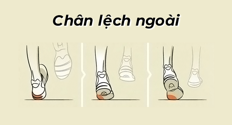 Chân lệch ngoài