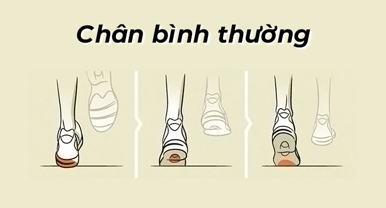 Chân bình thường