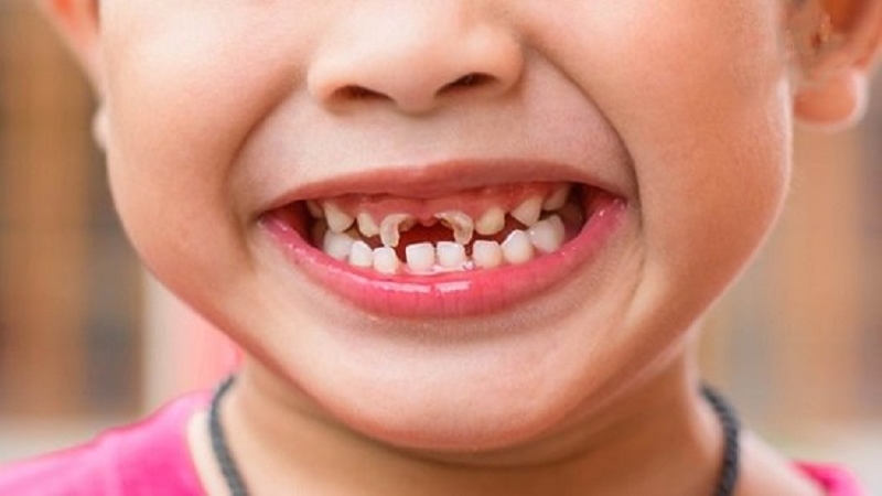 Đánh răng sau khi ăn lựu để tránh gặp các vấn đề về răng miệng