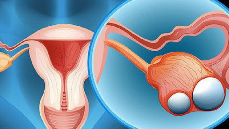 Xuất hiện khối u bên trên hoặc bên trong buồng trứng