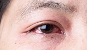 Đau mắt đỏ lây qua đường nào? Bao lâu thì khỏi?