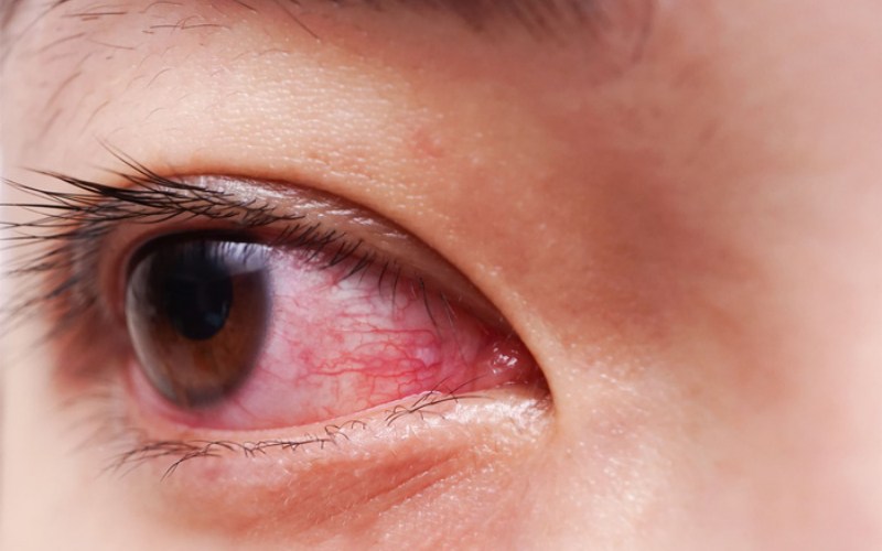 Bị đau mắt đỏ bao lâu thì khỏi? Điều cần biết về viêm kết mạc