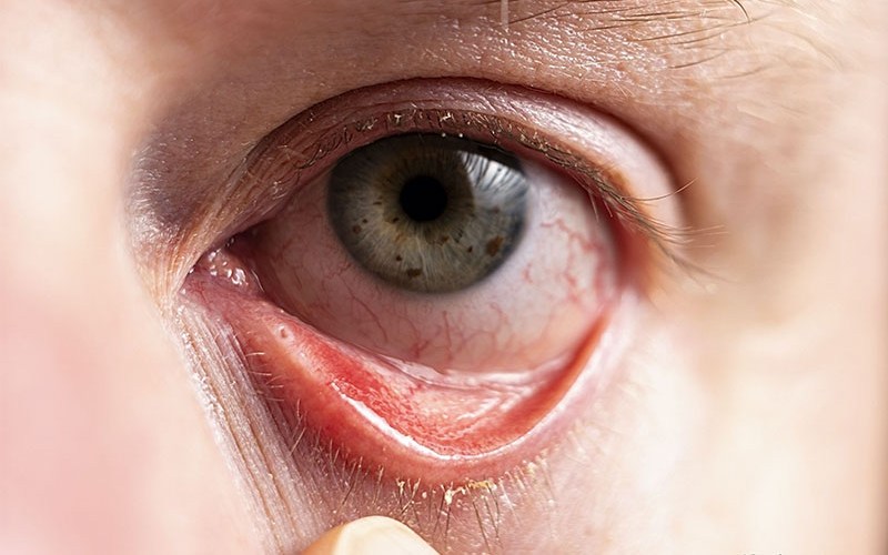 Đau mắt đỏ để lại biến chứng nghiêm trọng nếu không được chữa trị kịp thời