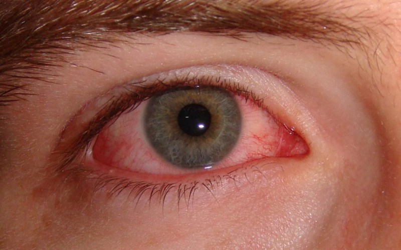 Bệnh đau mắt đỏ rất dễ nhầm lẫn với một số bệnh khác