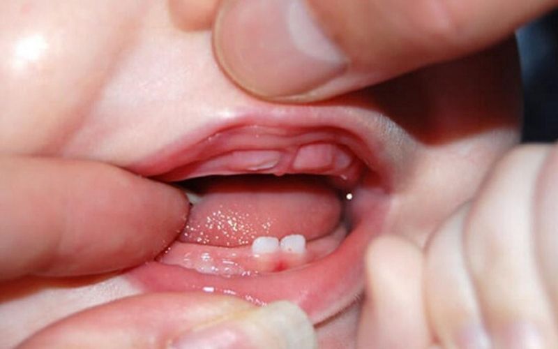 Sự giống và khác nhau giữa mọc răng hàm và răng thường