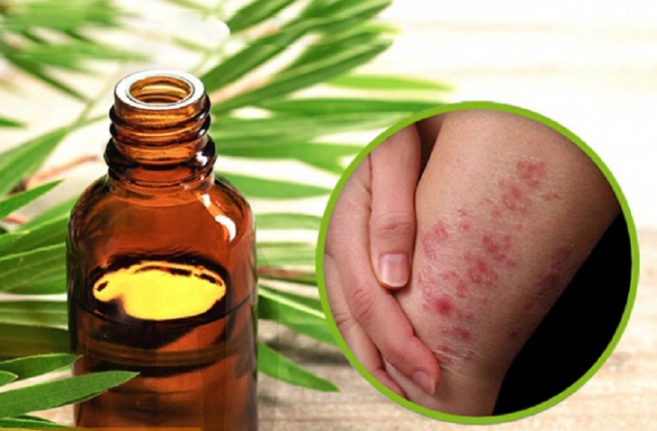 Giảm ngứa, dị ứng cho bé