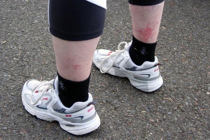Tại sao chạy bộ lại bị ngứa chân? Nguyên nhân và cách khắc phục > Viêm mạch