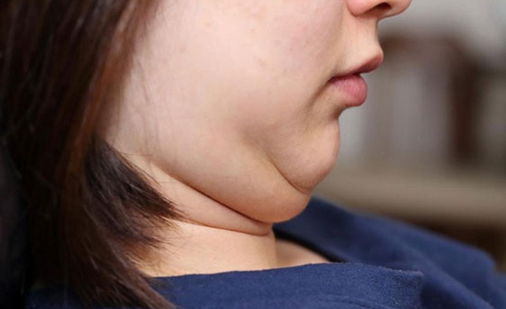 Lý do cho chất béo trên khuôn mặt là gì?