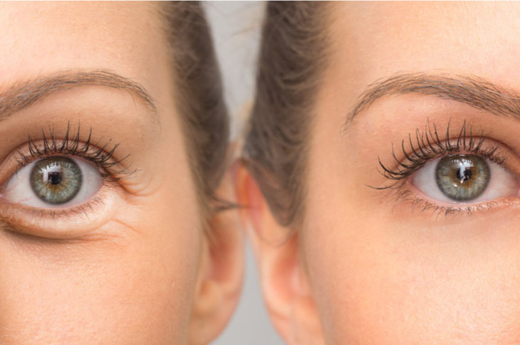 signs of aging in the eye area