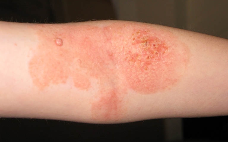 Contact dermatitis causes darkened skin