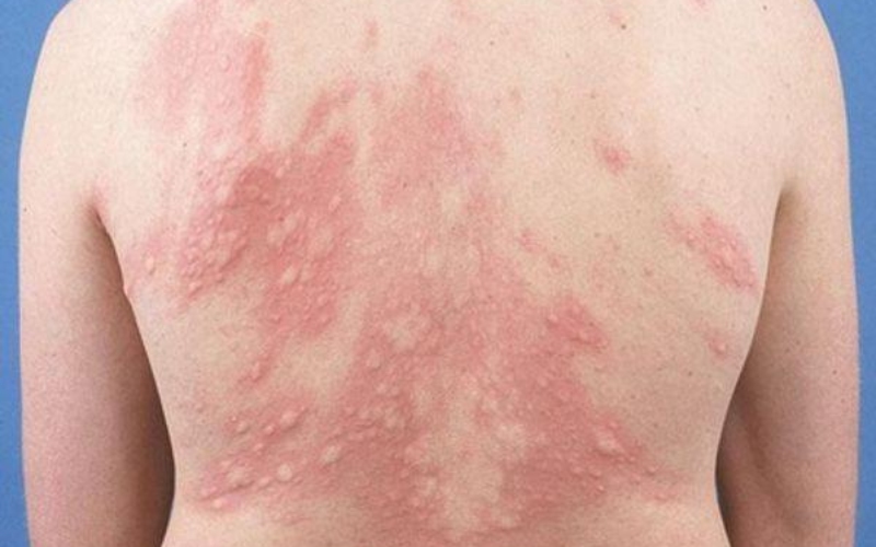 Urticaria has many risks to the body
