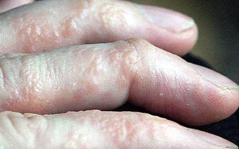Scabies on the hand
