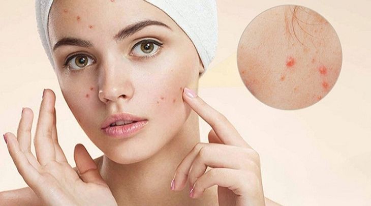 Consider the acne condition before using a face wash machine