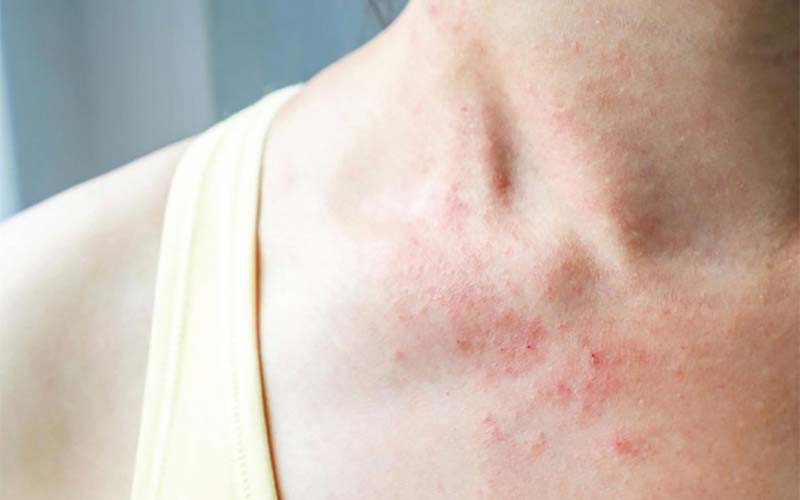 What is Eczema? What to fast and what to eat to quickly recover from illness?