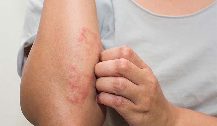 Bệnh chàm là gì? Kiêng gì và ăn gì để nhanh khỏi bệnh nhất?