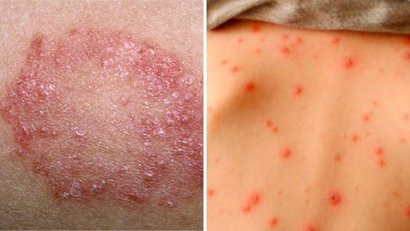 Hội chứng Ramsay Hunt do nhiễm virus varicella-zoster gây bệnh zona và thủy đậu