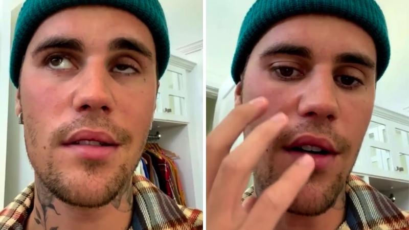 Justin Bieber bị liệt nửa mặt do nhiễm virus hiếm