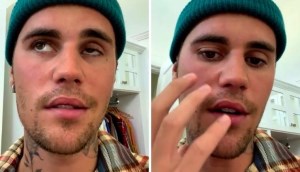 Loại virus khiến Justin Bieber bị liệt nửa mặt nguy hiểm đến thế nào?