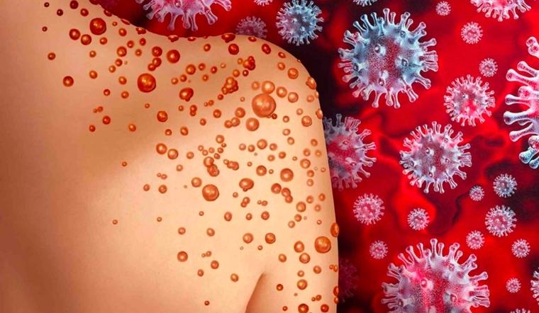 Bệnh đậu mùa khỉ là gì? Nguyên nhân, triệu chứng và cách phòng tránh