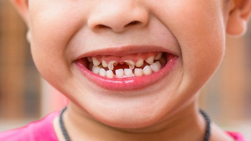 Trẻ dễ bị sâu răng