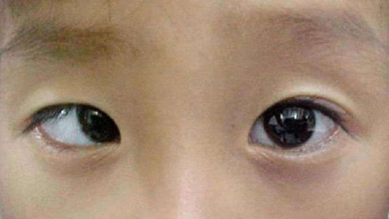 Tật lác mắt ở trẻ em