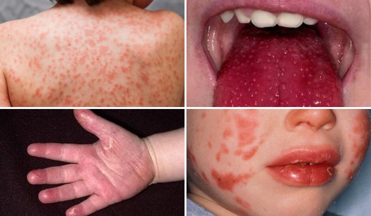 Bệnh Kawasaki ở trẻ em có nguy hiểm không? Triệu chứng và cách chăm sóc trẻ 