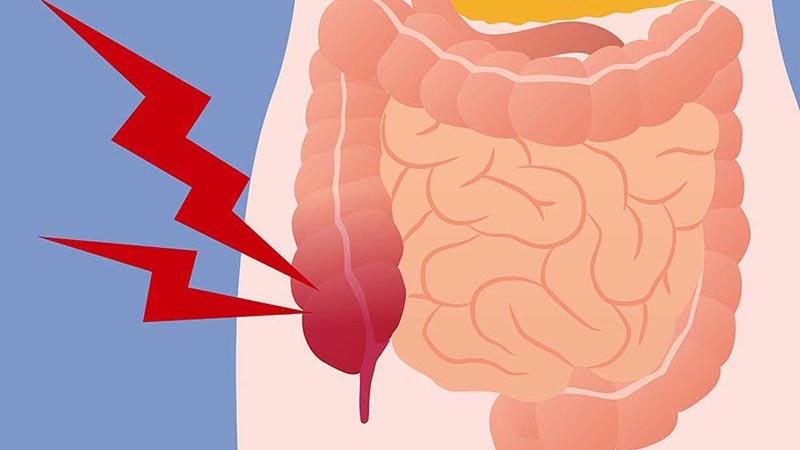 Vị trí đau ruột thừa