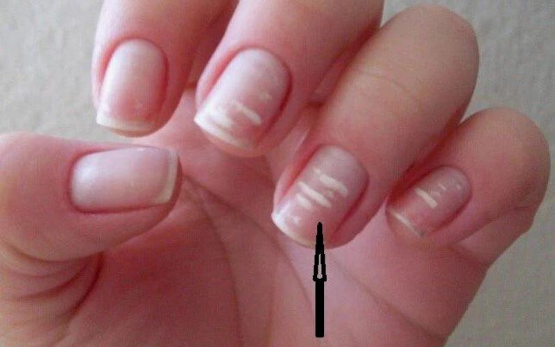 What are white spot nails? Decoding the grain of rice on the nail