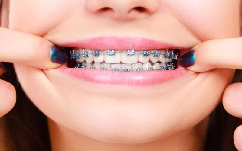 What are braces? Benefits, costs and objects of braces