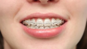 Niềng răng là gì? Lợi ích, chi phí và đối tượng niềng răng