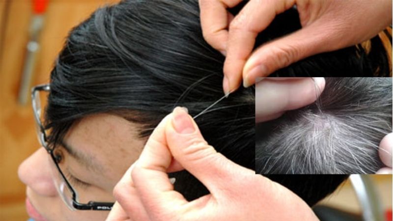 Treatment and causes of premature graying of hair in children