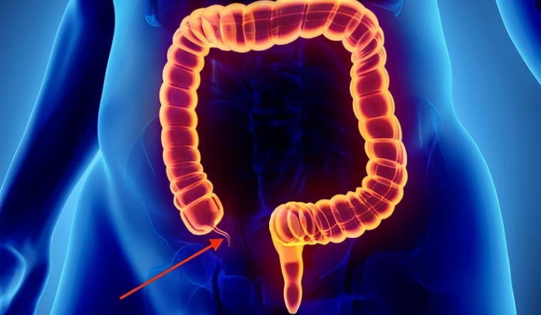 Đau ruột thừa bên nào? Dấu hiệu nhận biết và cách điều trị