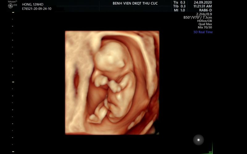 Sự phát triển của thai nhi trong bụng suốt 9 tháng thai kỳ Nhiều ảnh mẹ  bầu cực sốc