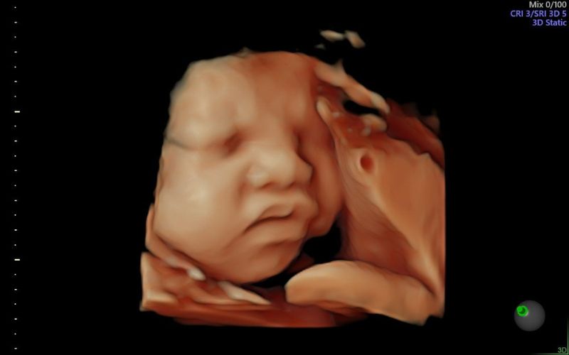 Sự phát triển hình ảnh túi thai 4 tuần tuổi và những thay đổi của mẹ   HelloBacsi