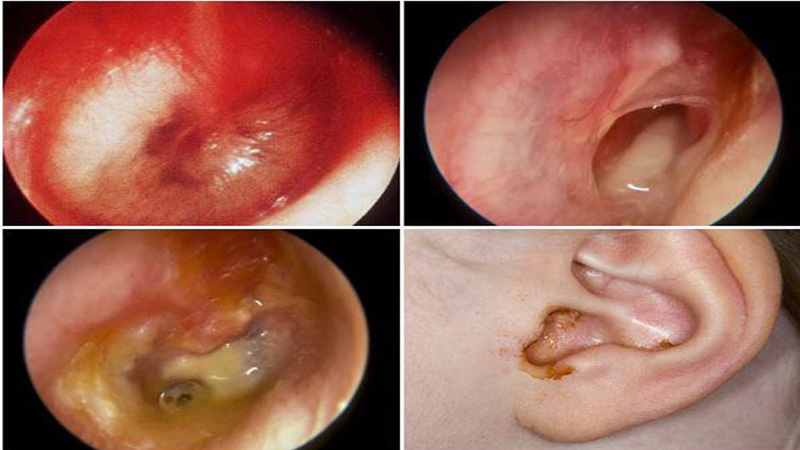 3 nguyên nhân viêm tai giữa có thể bạn chưa biết