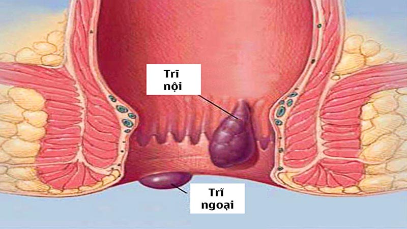 Bệnh trĩ là căn bệnh gây ra nhiều khó chịu cho bệnh nhân