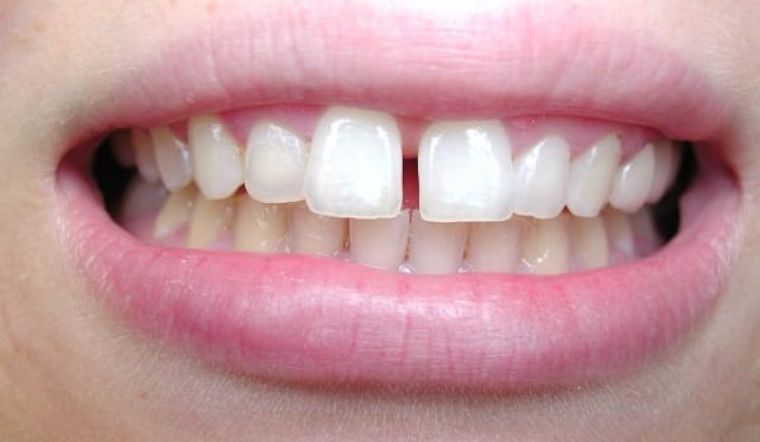 Răng thưa nên làm gì? 5 phương pháp điều trị răng thưa tại nhà