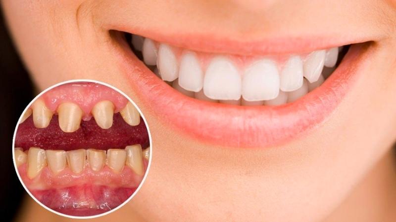 Răng thưa nên làm gì? 5 phương pháp điều trị răng thưa tại nhà
